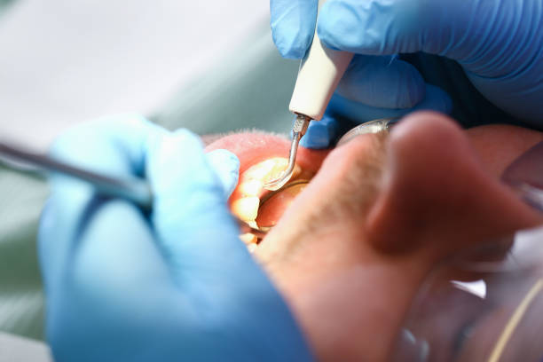 Best Knocked-Out Tooth (Avulsed Tooth) Treatment in Belton, MO