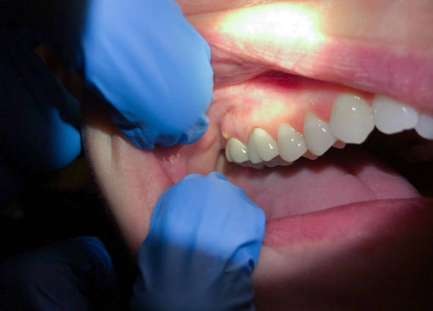 Best Emergency Denture Repair in Belton, MO