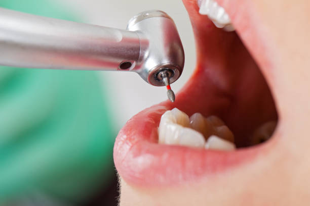 Best Emergency Root Canal Therapy in Belton, MO